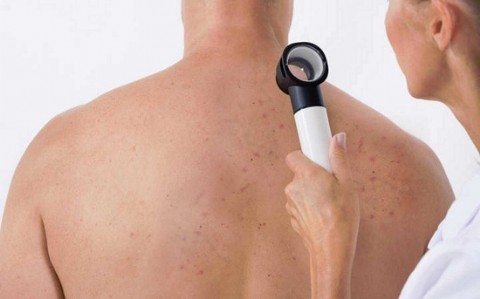 Salta está entre las provincias con más consultas por cáncer de piel